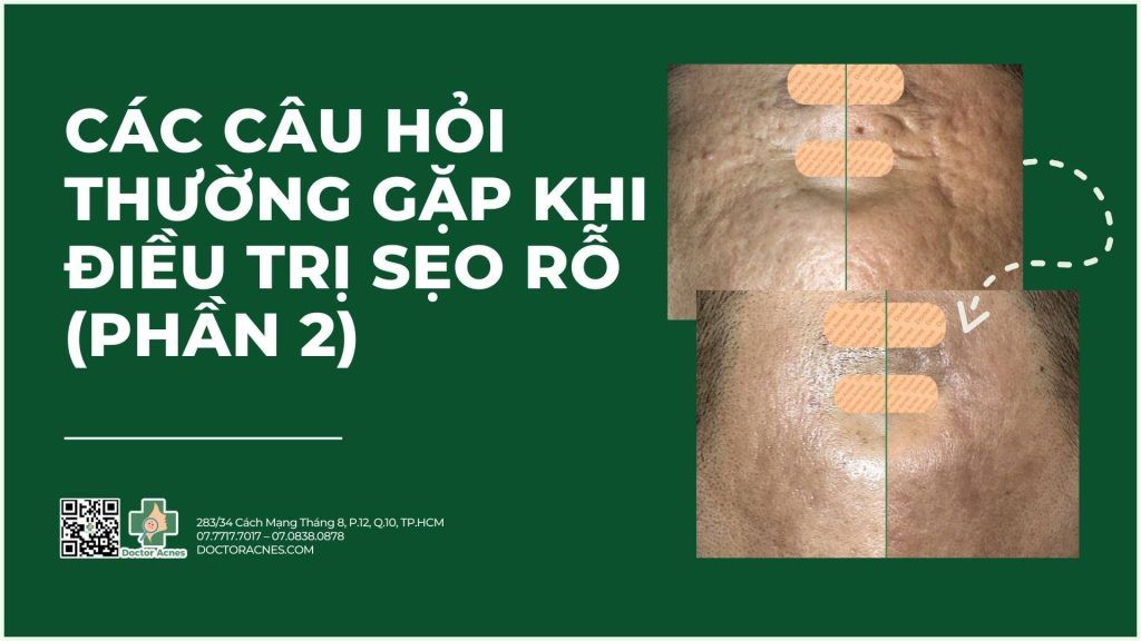 các câu hỏi thường gặp khi điều trị sẹo rỗ (phần 2)