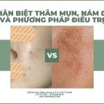 Phân biệt thâm mụn, nám da và phương pháp điều trị
