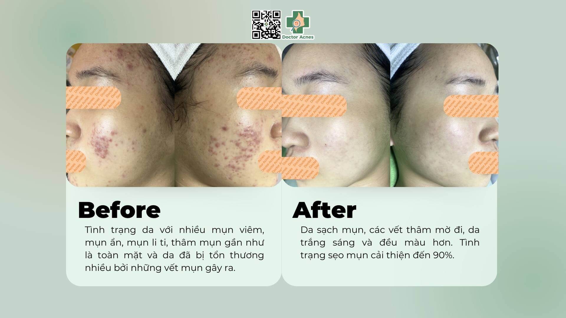 Hình ảnh trước và sau điều trị tại Doctor Acnes của bạn Hoàng Oanh