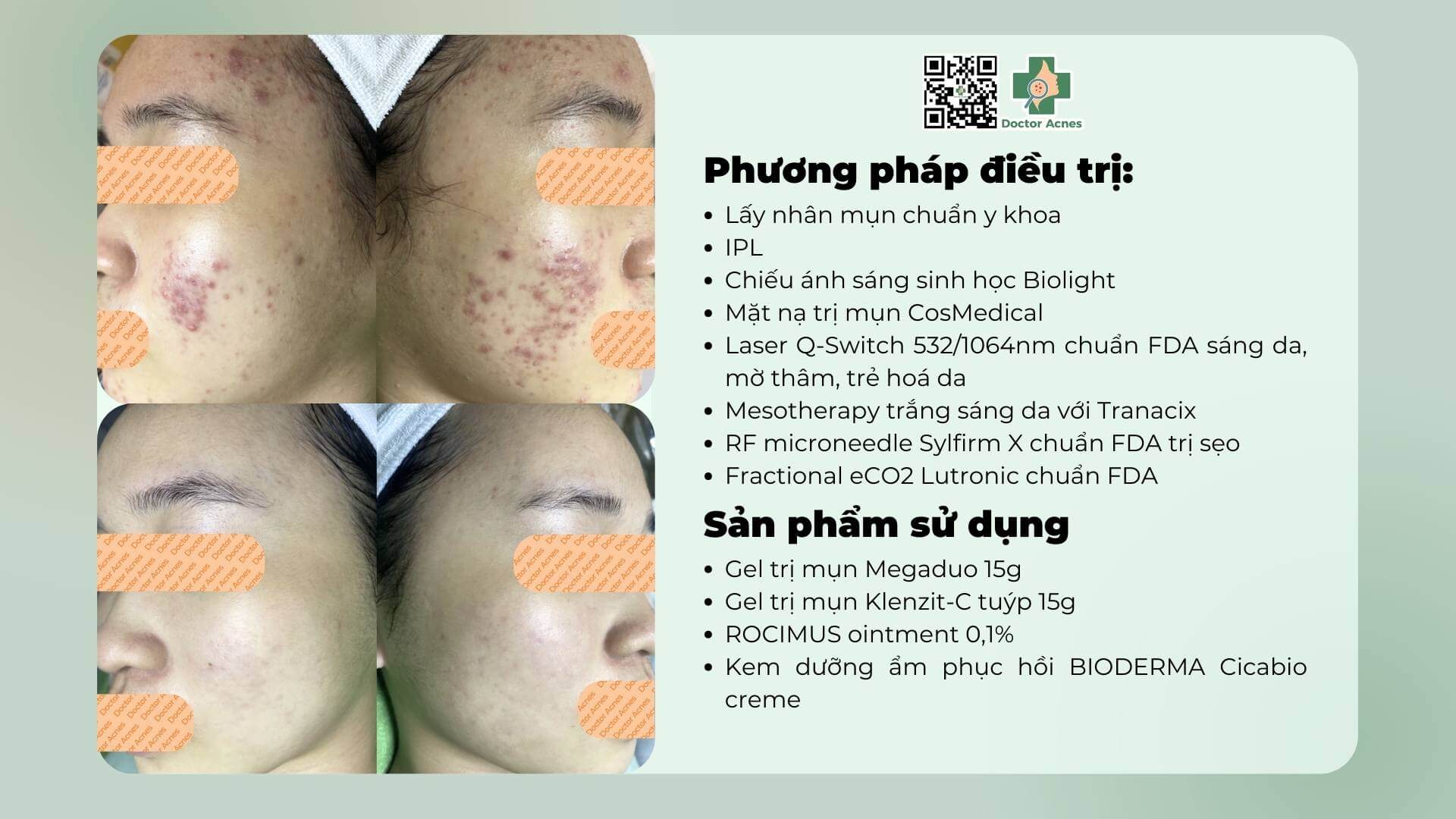 Hình ảnh trước và sau khi điều trị sẹo của khách hàng Hoàng Oanh tại Phòng khám Doctor Acnes