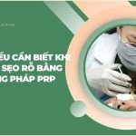 Những điều cần biết khi điều trị sẹo rỗ bằng phương pháp PRP