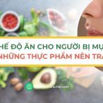 Chế độ ăn cho người bị mụn và những thực phẩm nên tránh