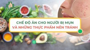 Chế độ ăn cho người bị mụn và những thực phẩm nên tránh