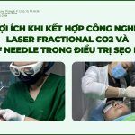 Lợi ích khi kết hợp công nghệ laser fractional CO2 và RF needle trong điều trị sẹo rỗ