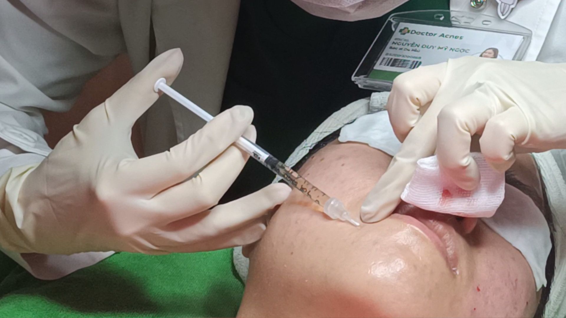Mesotherapy trị mụn Doctor Acnes