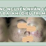 Những nguyên nhân gây thất bại khi điều trị mụn