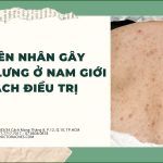Nguyên nhân gây mụn ở lưng nam giới và cách điều trị