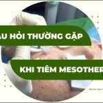 Các câu hỏi thường gặp khi tiêm mesotherapy (phần 2)