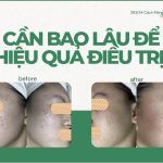 Thời gian điều trị mụn là bao lâu để hết mụn?
