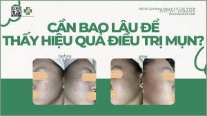 trị mụn bao lâu thì khỏi