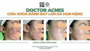 Doctor acnes - chìa khóa đánh bay làn da mụn nặng