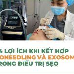 Top 4 lợi ích khi kết hợp RF microneedle và exosome trong điều trị sẹo
