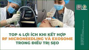 Top 4 lợi ích khi kết hợp RF microneedling và exosome trong điều trị sẹo