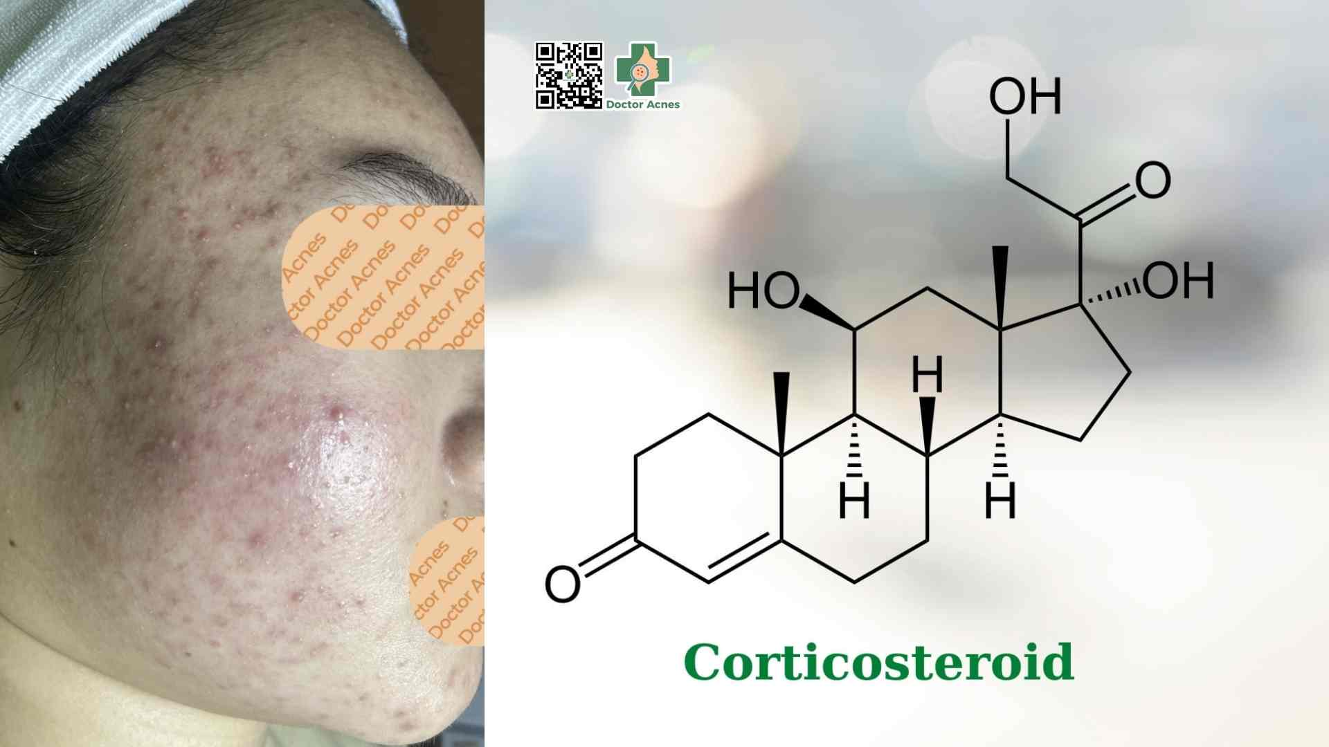 corticosteroid là một loại hormone