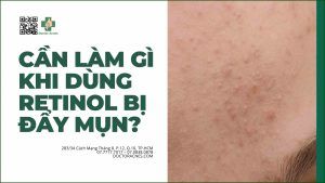 Cần làm gì khi dùng retinol bị đẩy mụn