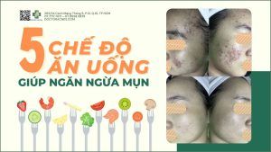 5 chế độ ăn uống giúp ngăn ngừa mụn