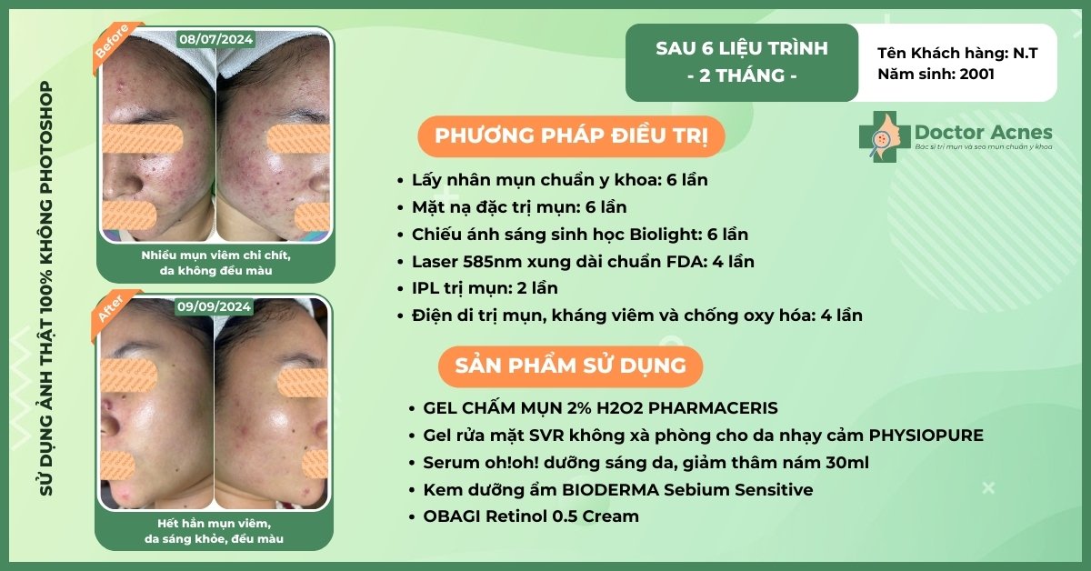 ca lâm sàng điều trị mụn, thâm có dùng retinol