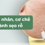Sẹo rỗ là gì: nguyên nhân, phân loại và cơ chế hình thành sẹo rỗ