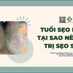 Tuổi sẹo là gì? Tại sao nên điều trị sẹo sớm?
