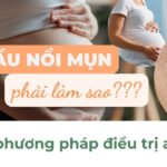 Bà bầu nổi mụn phải làm sao? 4 phương pháp điều trị an toàn