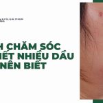 Da tiết nhiều dầu: nguyên nhân và cách chăm sóc da tiết nhiều dầu