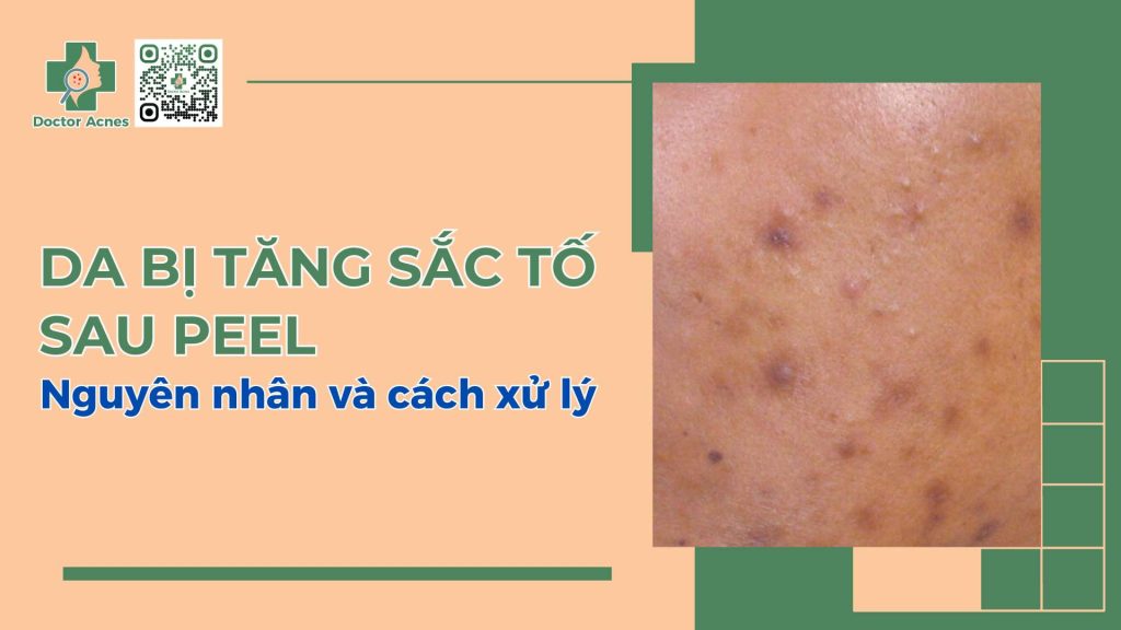Da bị tăng sắc tố sau peel