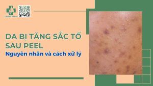 Da bị tăng sắc tố sau peel - Nguyên nhân và cách xử lý