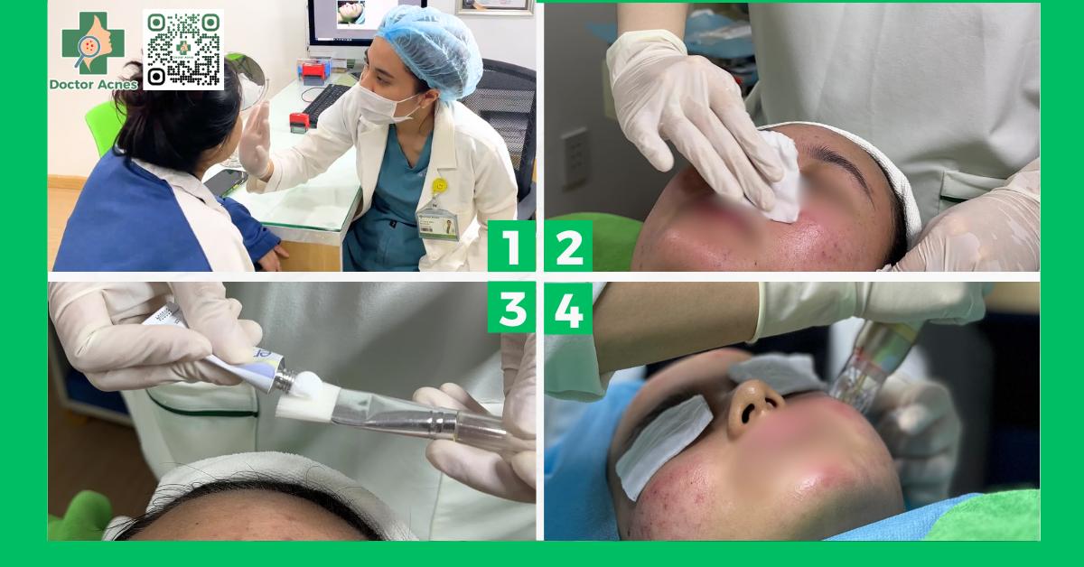 Quy trình điều trị sẹo rỗ bằng phương pháp RF microneedle