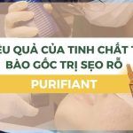Hiệu quả của tinh chất tế bào gốc trị sẹo rỗ Purifiant