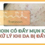 Tretinoin có đẩy mụn không? Cách xử lý khi da bị đẩy mụn