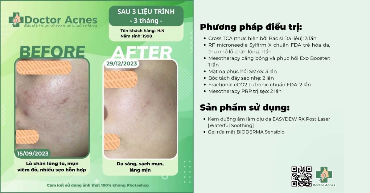 ca lâm sàng thu nhỏ lỗ chân lông thành công bằng laser