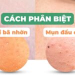 Cách phân biệt sợi bã nhờn và mụn đầu đen