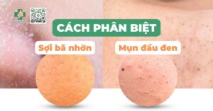 Cách phân biệt sợi bã nhờn và mụn đầu đen