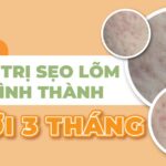 Tổng hợp cách trị sẹo lõm mới hình thành