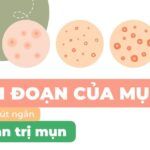 4 giai đoạn của mụn: hiểu rõ để rút ngắn thời gian trị mụn