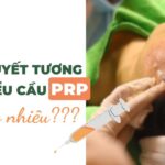 Chi phí tiêm huyết tương giàu tiểu cầu PRP giá bao nhiêu?