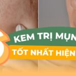 Top 6 kem trị mụn ẩn hiệu quả nhất hiện nay