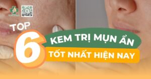 kem trị mụn ẩn