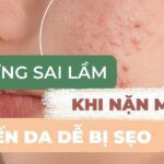 6 sai lầm khi nặn mụn khiến da dễ bị sẹo thâm