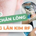 Thu nhỏ lỗ chân lông bằng lăn kim RF