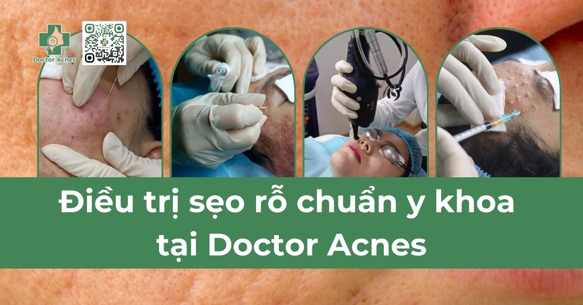 Liệu trình trị sẹo rỗ giá bao nhiêu tiền - Doctor Acnes