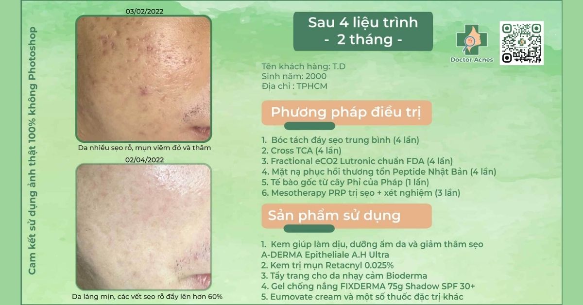 ca lâm sàng điều trị sẹo rỗ thành công tại doctor acnes