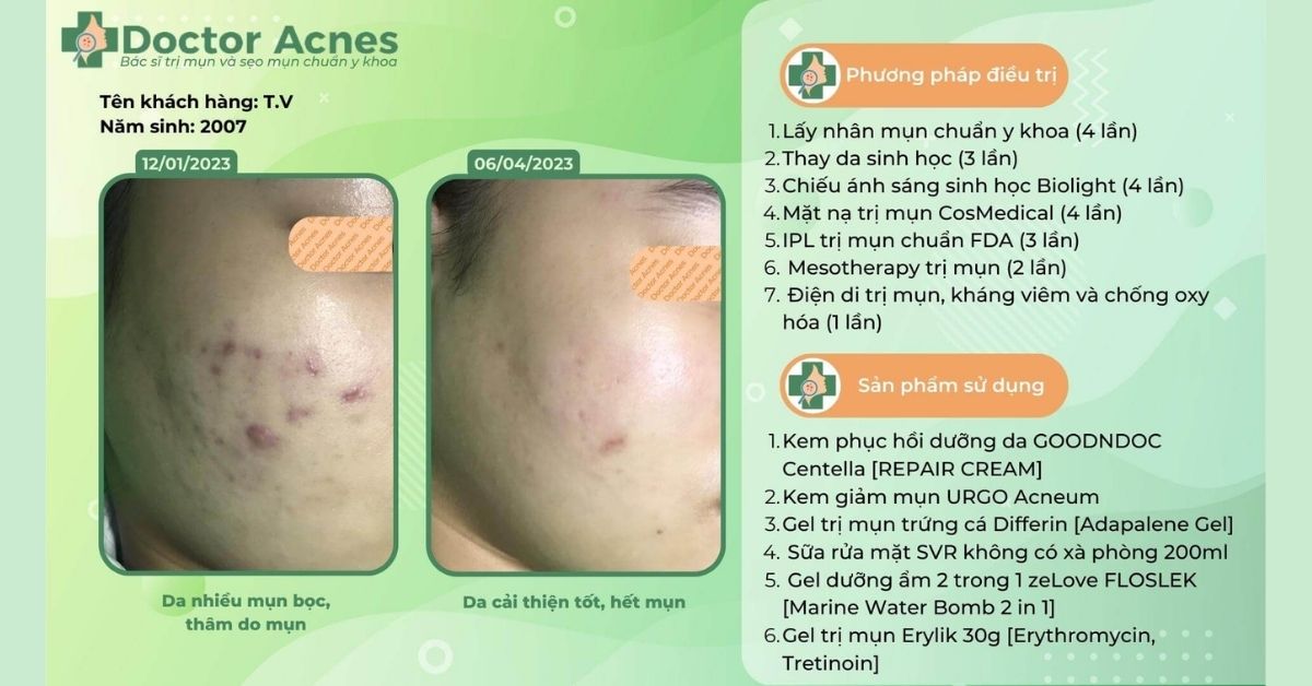 ca lâm sàng phục hồi da bằng phương pháp điện di tại Doctor Acnes