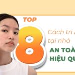 Top 8 cách trị mụn tại nhà hiệu quả và an toàn nhất