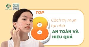 Top 8 cách trị mụn tại nhà hiệu quả và an toàn nhất