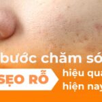 Các bước chăm sóc da bị sẹo rỗ hiệu quả nhất hiện nay