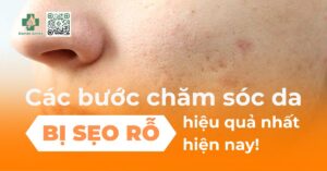 Các bước chăm sóc da bị sẹo rỗ hiệu quả nhất hiện nay