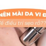 Có nên mài da vi điểm để điều trị sẹo rỗ?