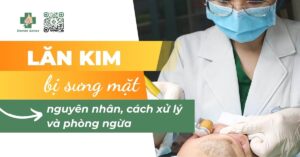 lăn kim bị sưng mặt