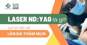 Laser Nd:YAG là gì? Lợi ích đối với làn da thâm mụn